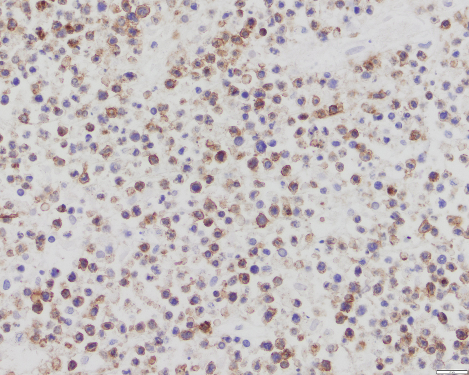 CD8 positive lymphoma cells