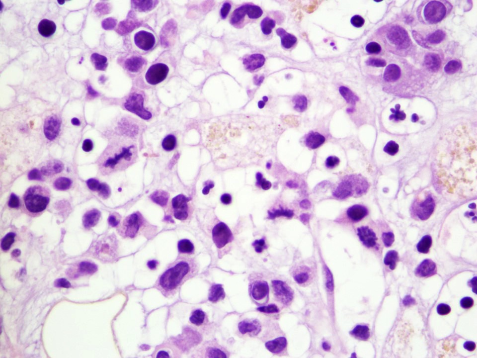Neoplastic cells involving the bone marrow