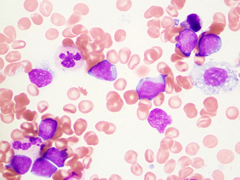 Neoplastic cells involving the bone marrow