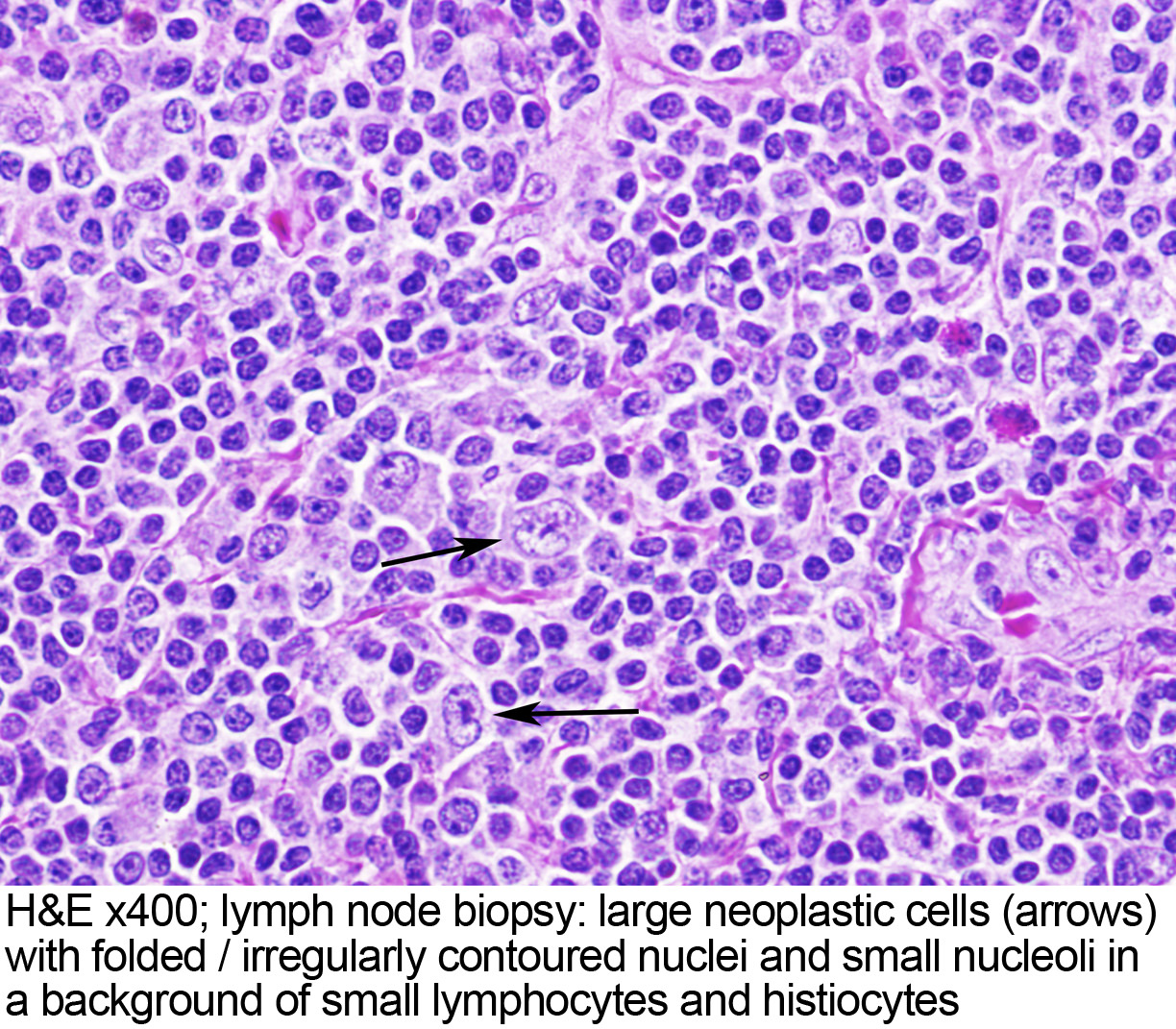 Pathology Outlines Nodular Lymphocyte Predominant