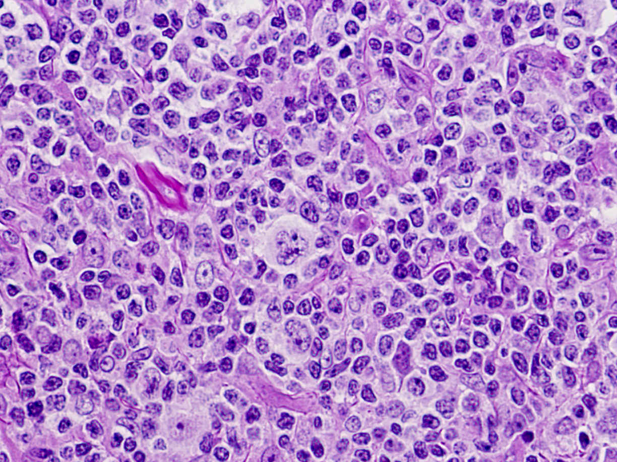 Pathology Outlines Nodular Lymphocyte Predominant