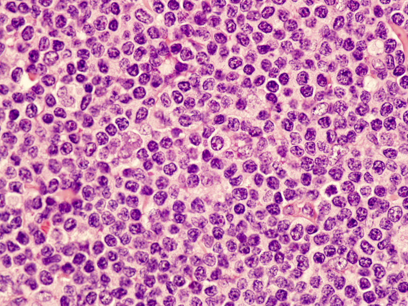 Intermediate size, atypical lymphocyte
