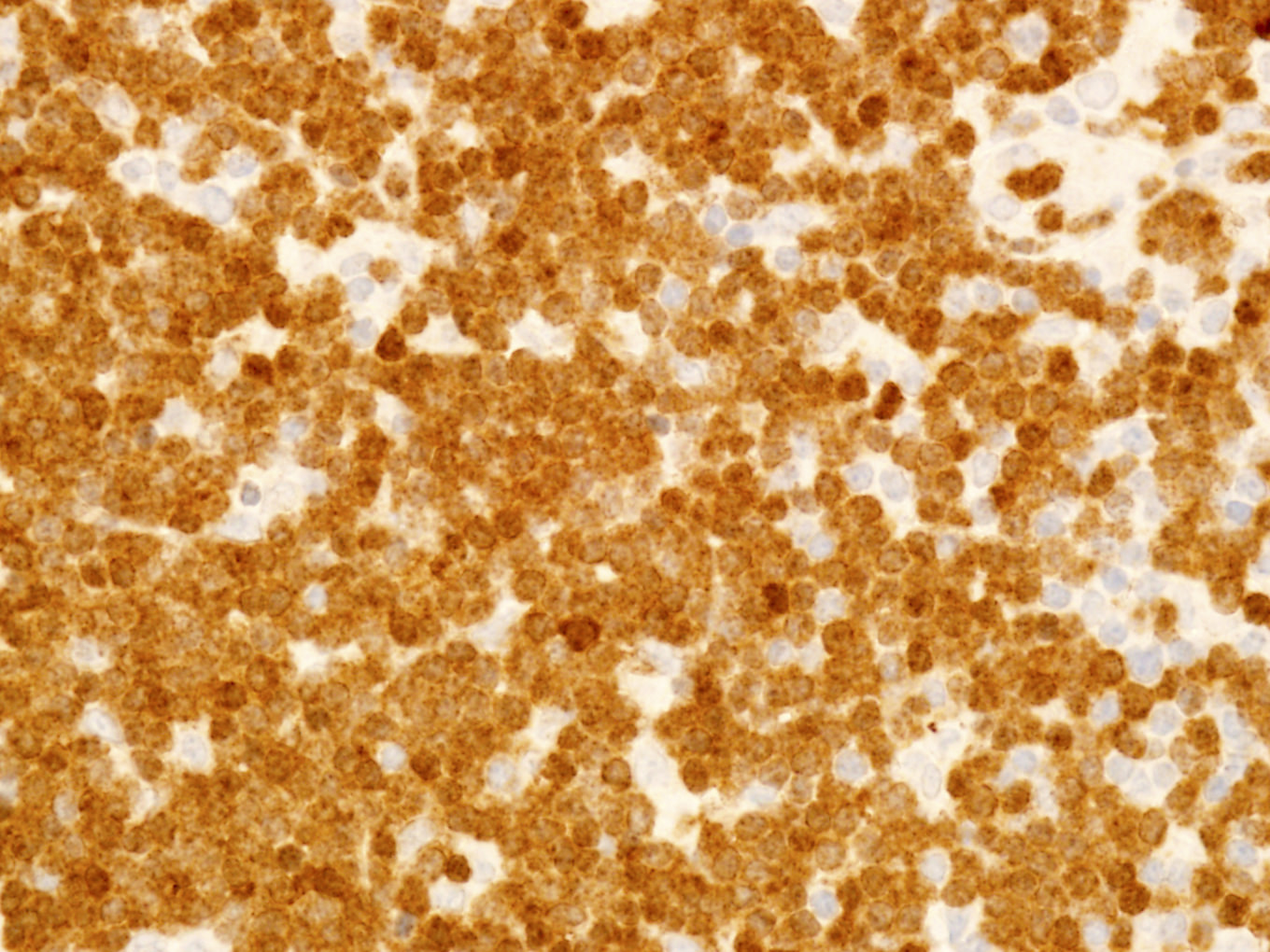 Uniform, strong TCL1A staining
