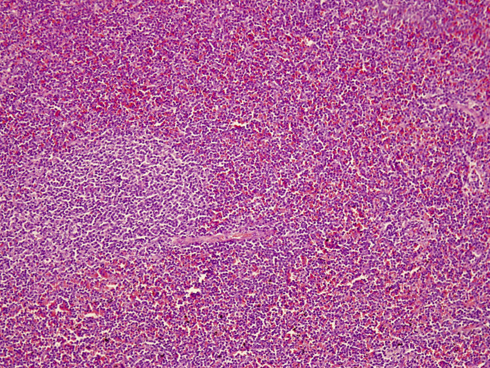 Splenic red pulp infiltrate