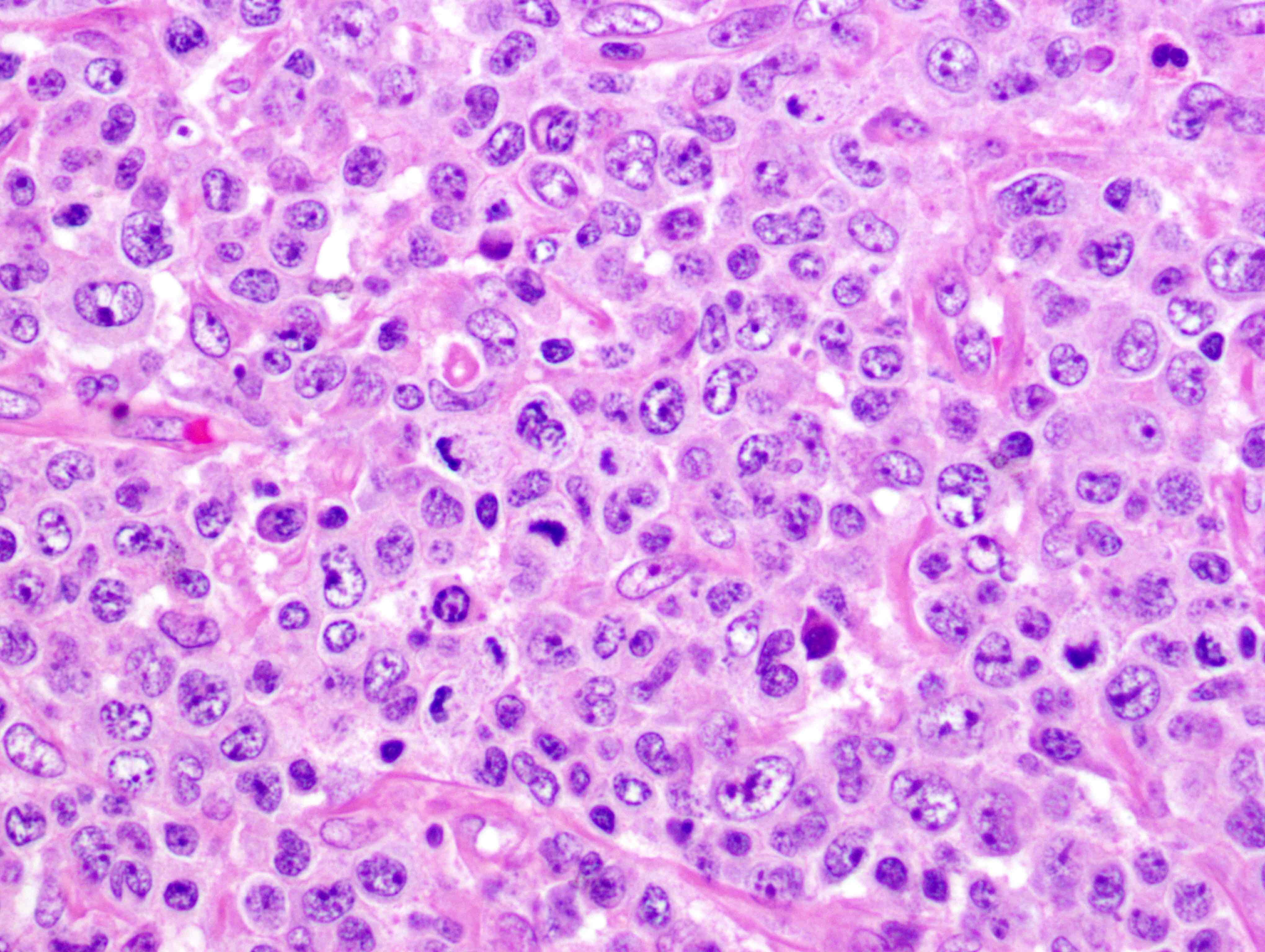 Pathology Outlines Peripheral T Cell Lymphoma Nos