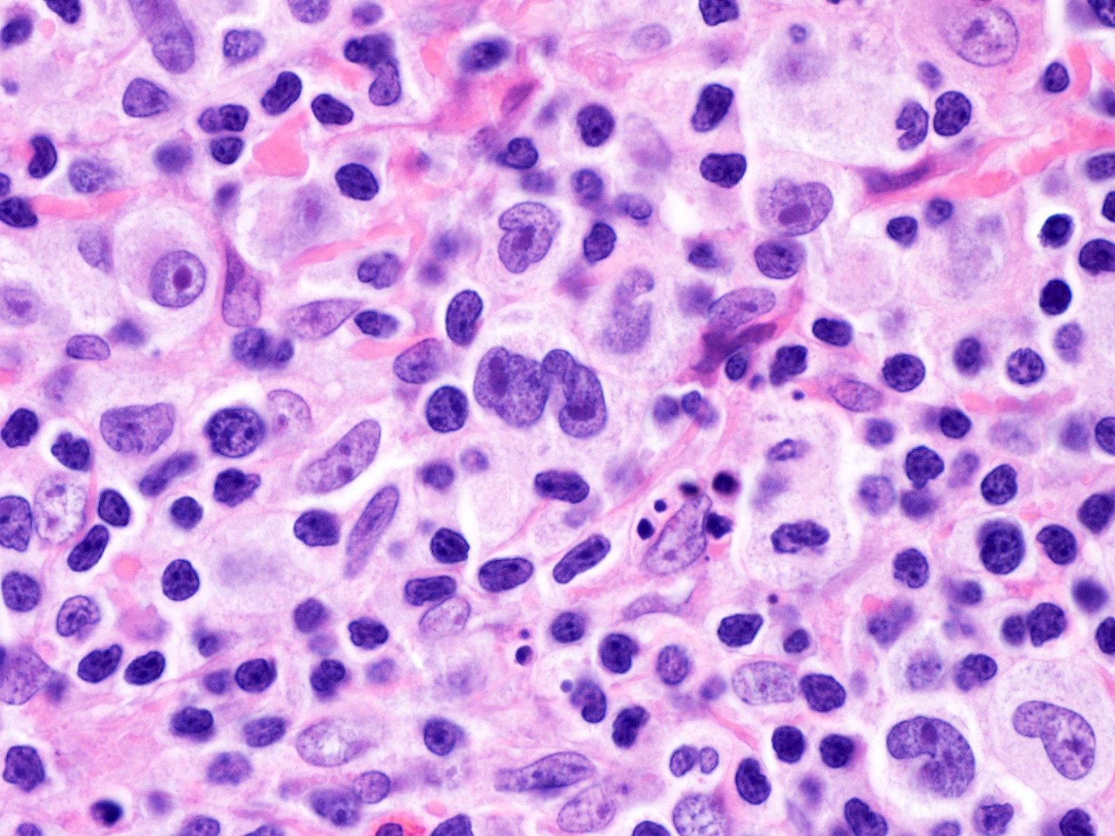 classical hodgkin lymphoma