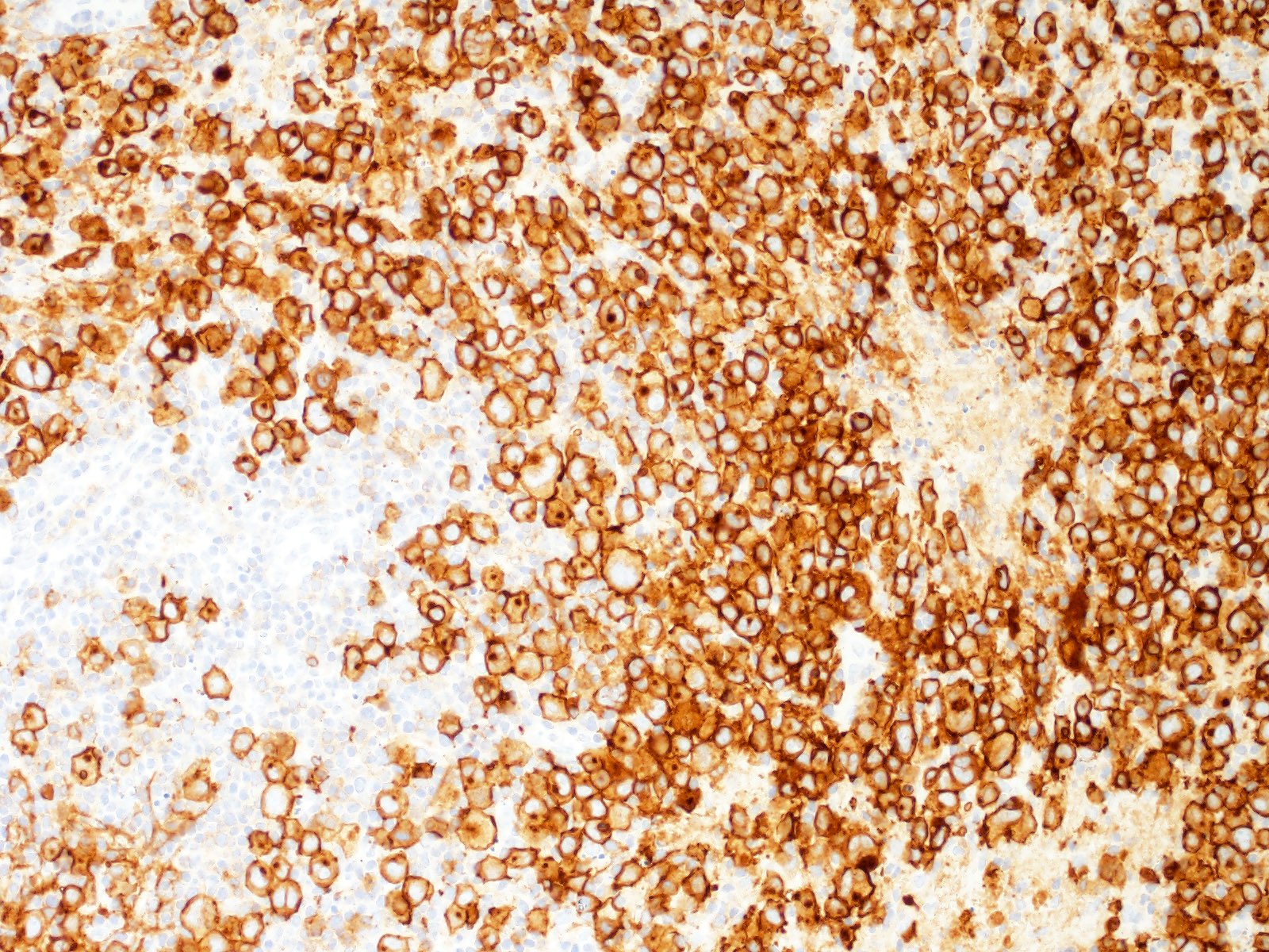 Syncytial variant, CD30 stain