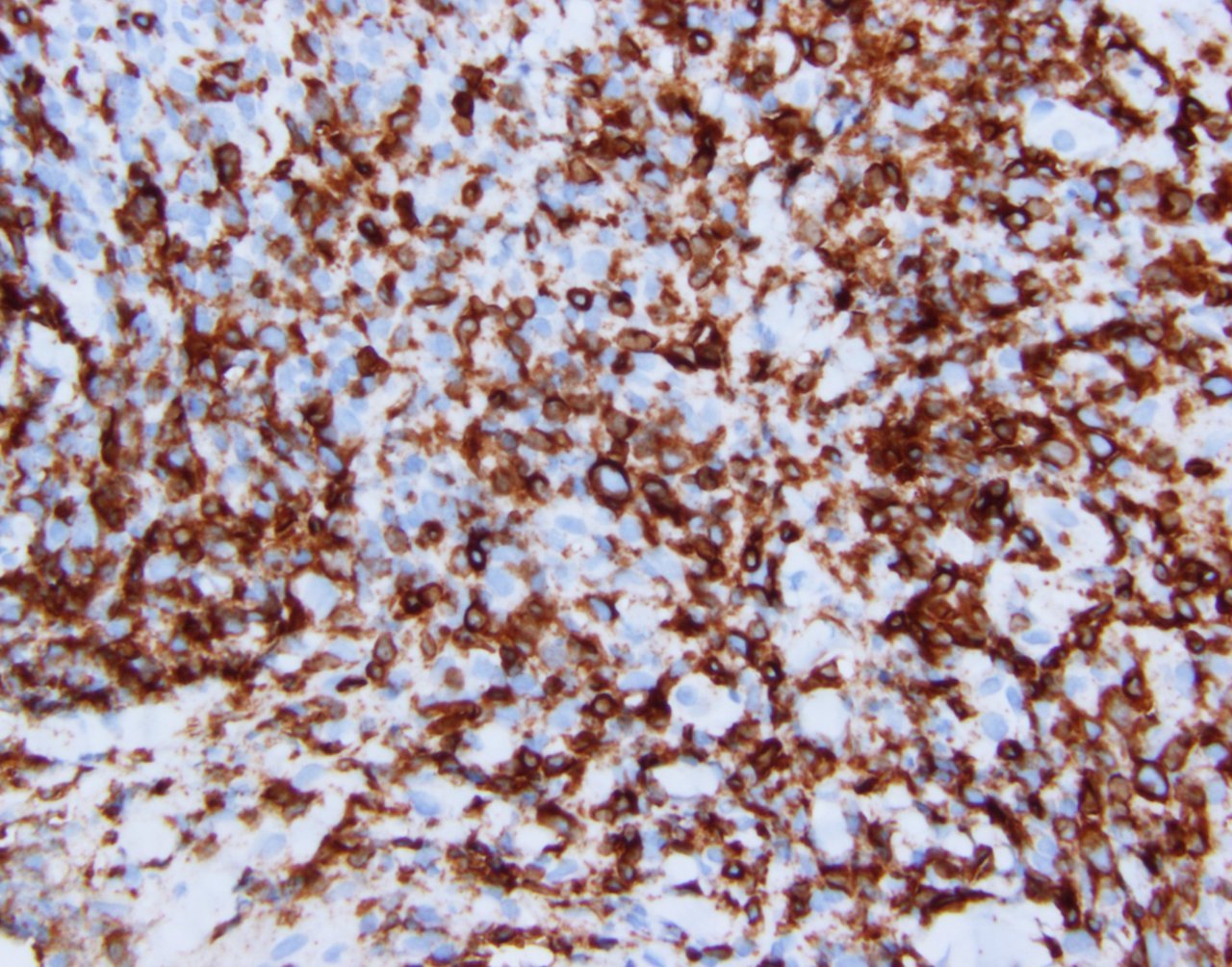 Neoplastic T cells showing strong CD3 expression