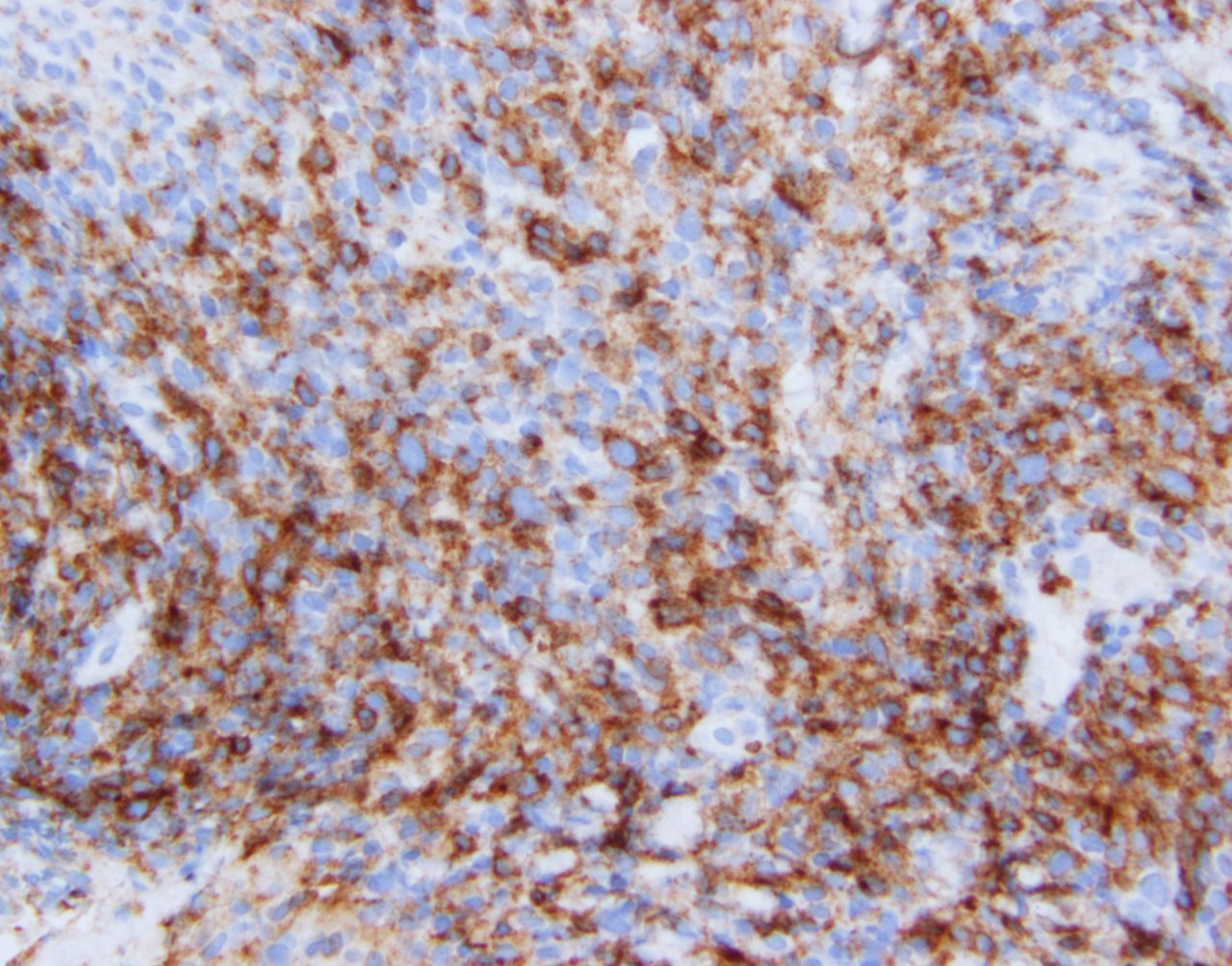 Neoplastic T cells showing strong CD4 expression