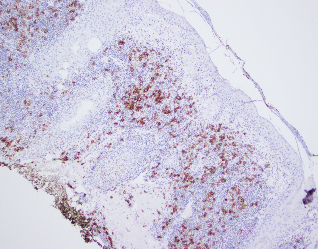 Neoplastic T cells showing strong PD-1 expression