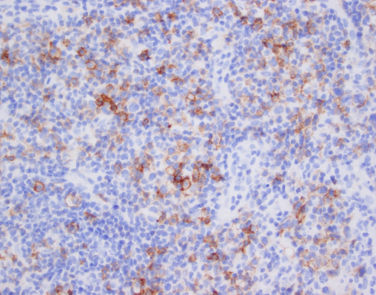 Neoplastic T cells showing strong ICOS expression