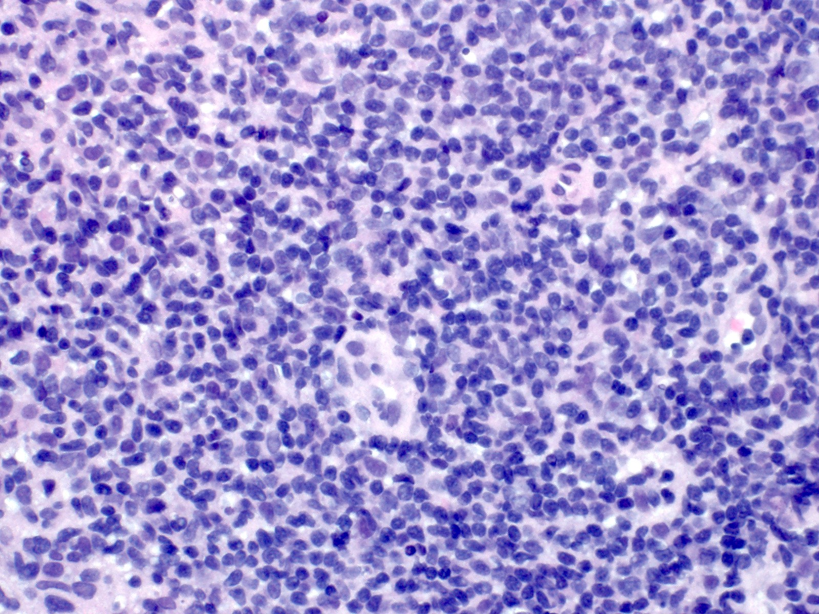 Atypical infiltrate of indolent T-LPD