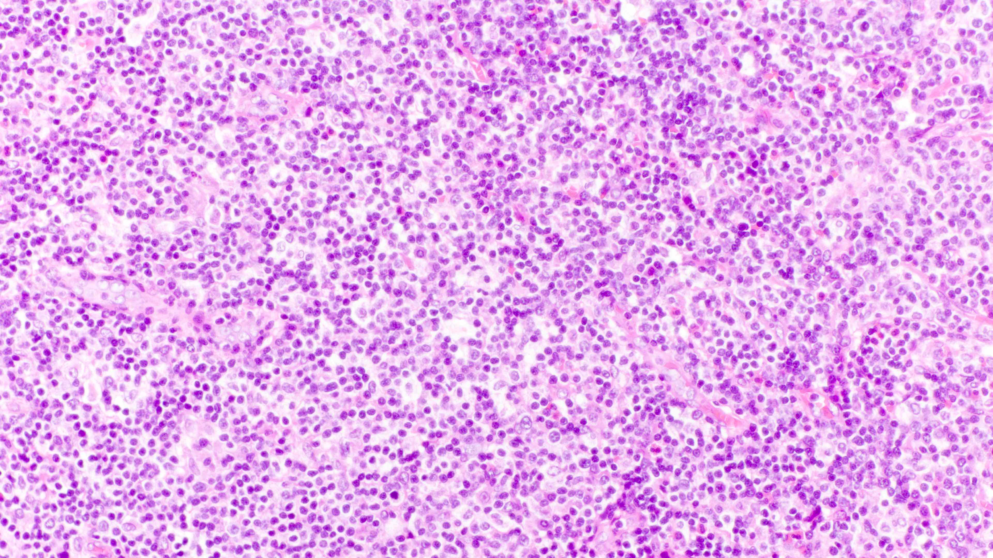 Polymorphic lymphoid infiltrate