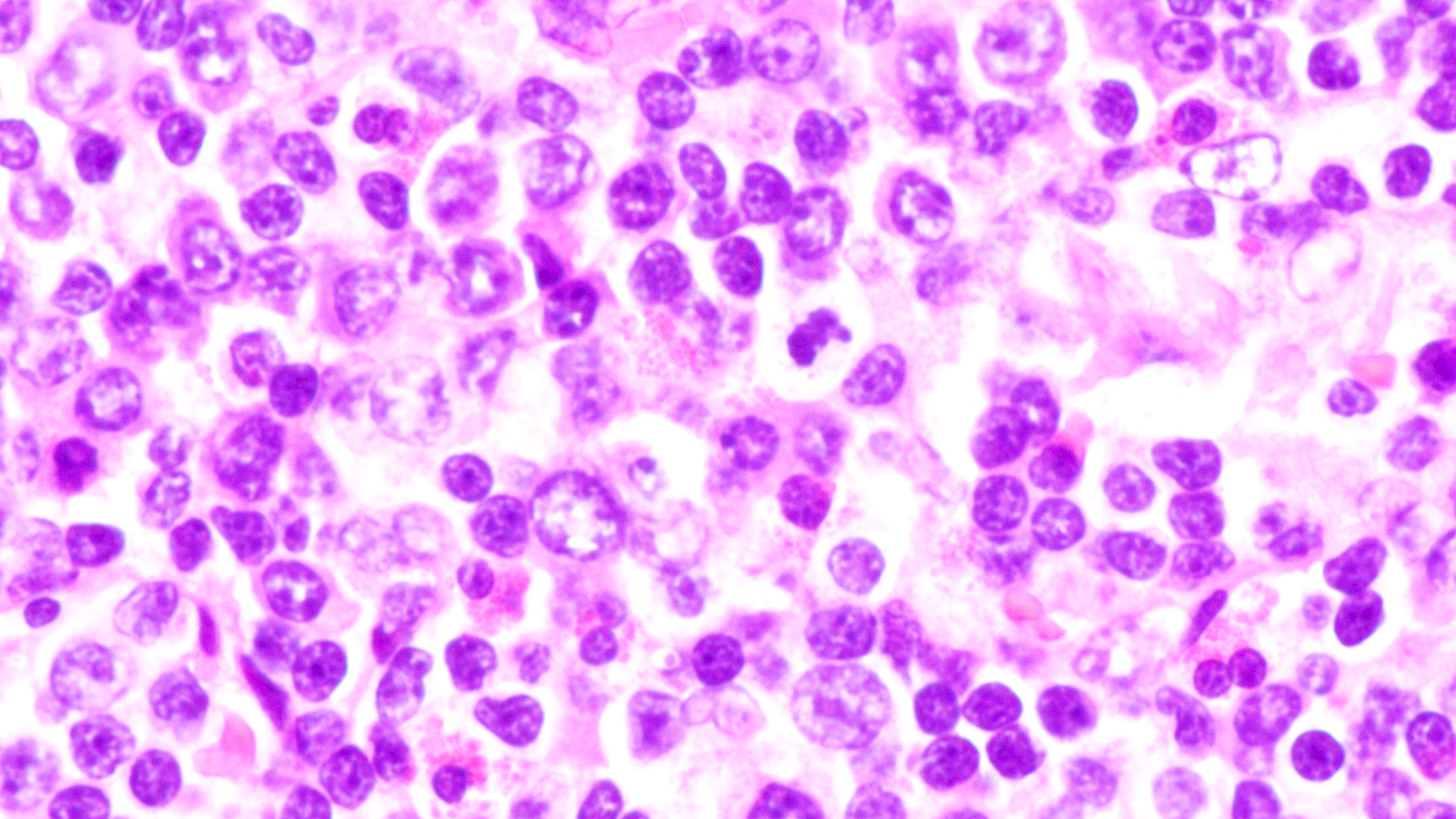 Composition of lymphoid infiltrate