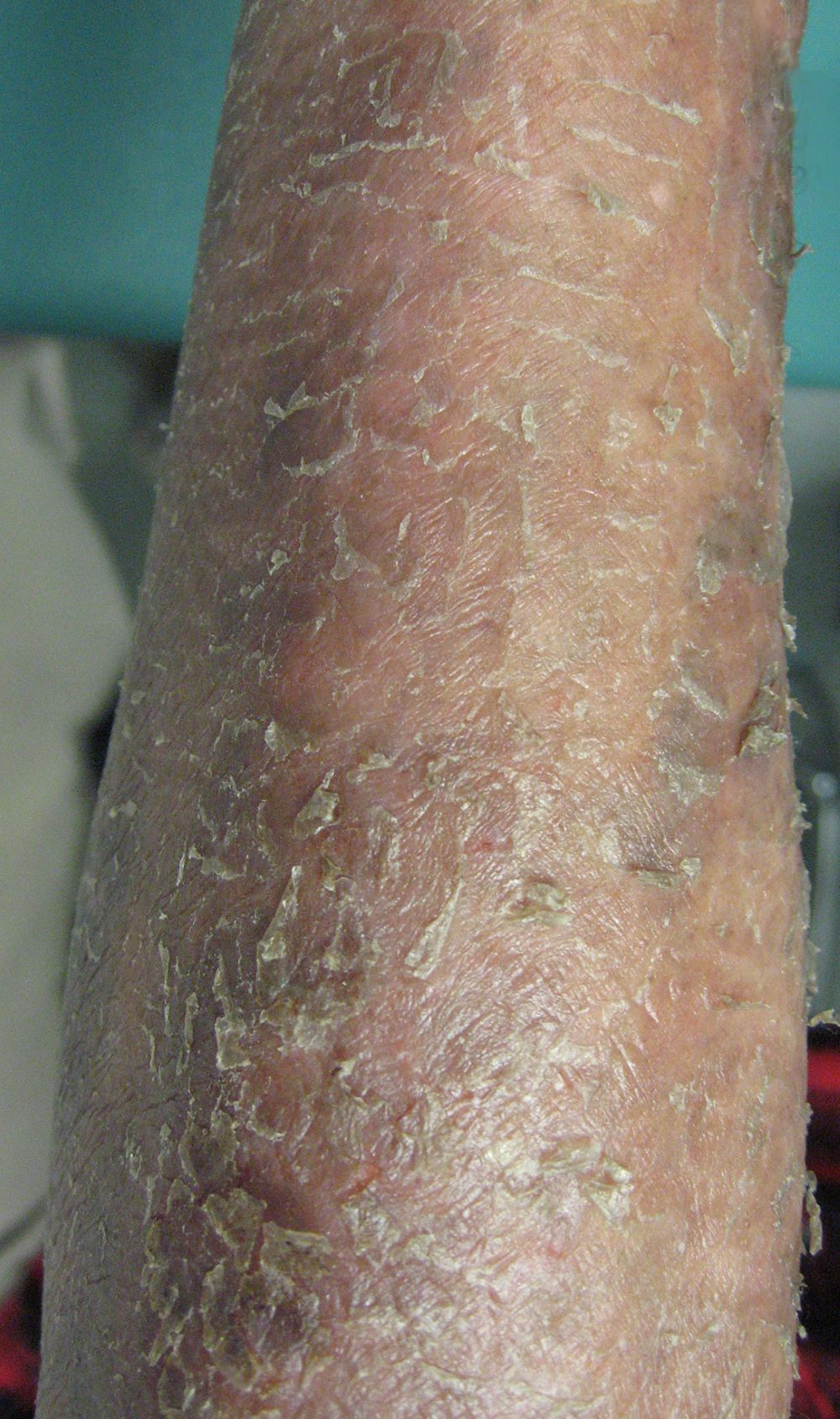 Prominent exfoliative lesion