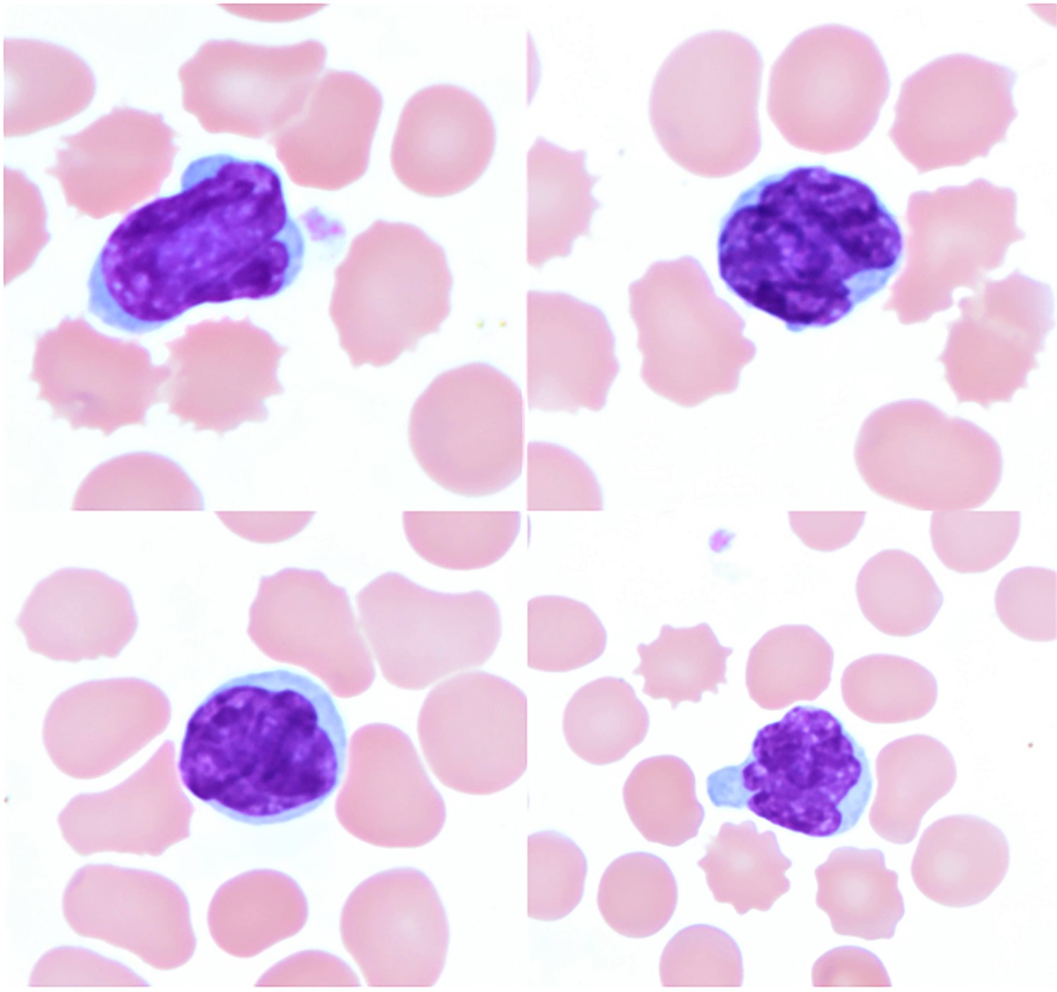 Cerebriform lymphocytes in peripheral blood smear