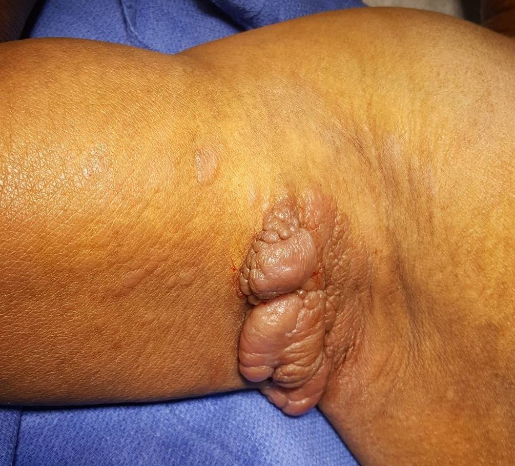 Mycosis fungoides, tumor stage