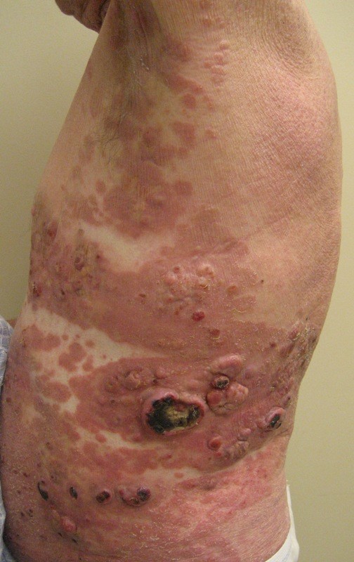 Mycosis fungoides, tumor stage
