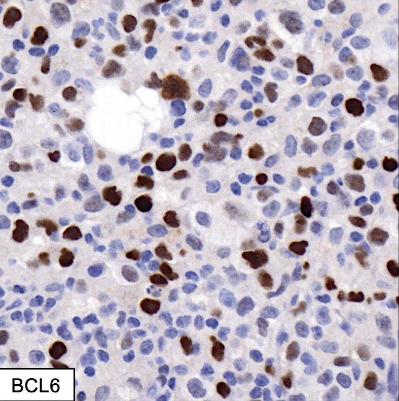 Pathology Outlines - DLBCL-primary testicular