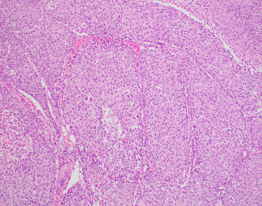 Macrotrabecular massive hepatocellular carcinoma