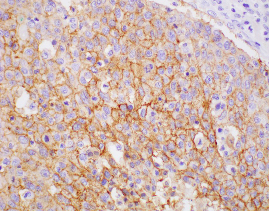 Macrotrabecular massive hepatocellular carcinoma