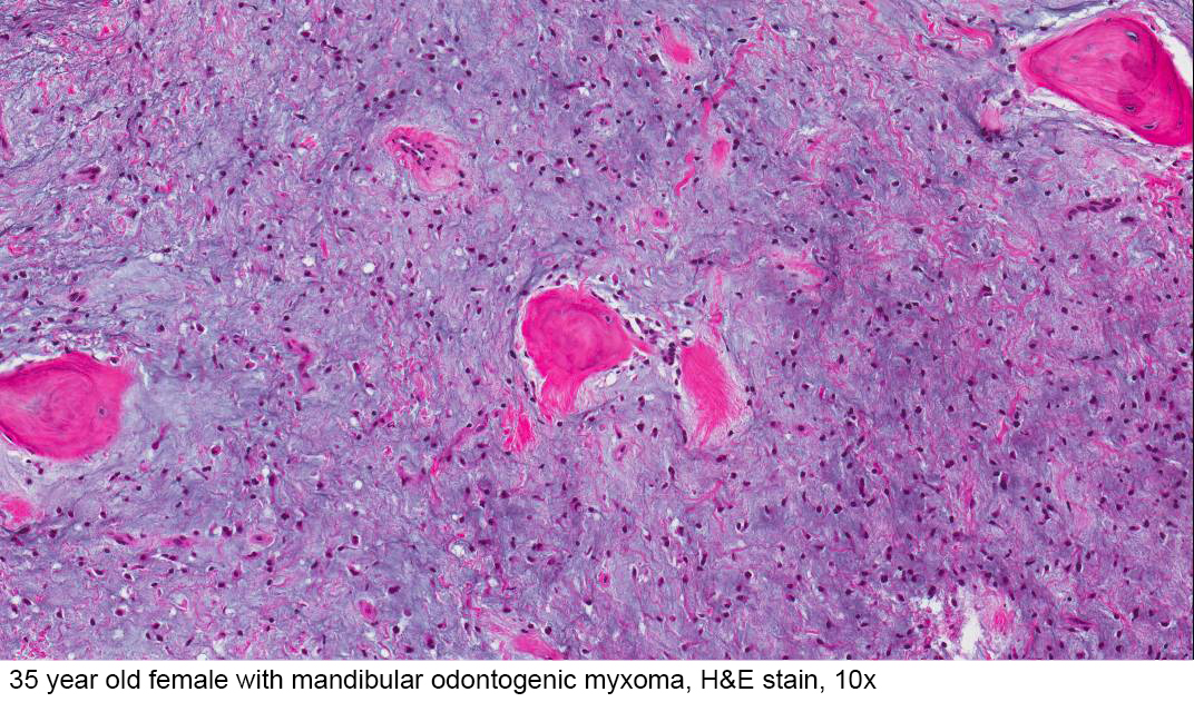 Pathology Outlines Odontogenic Myxoma Myxofibroma.
