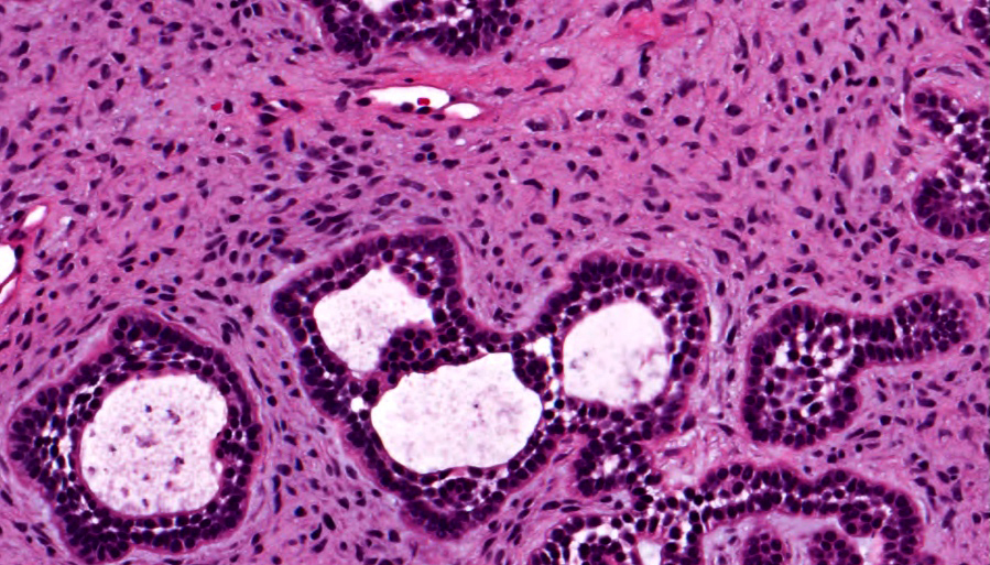 Odontogenic islands with cystic change, within immature mesenchymal stroma