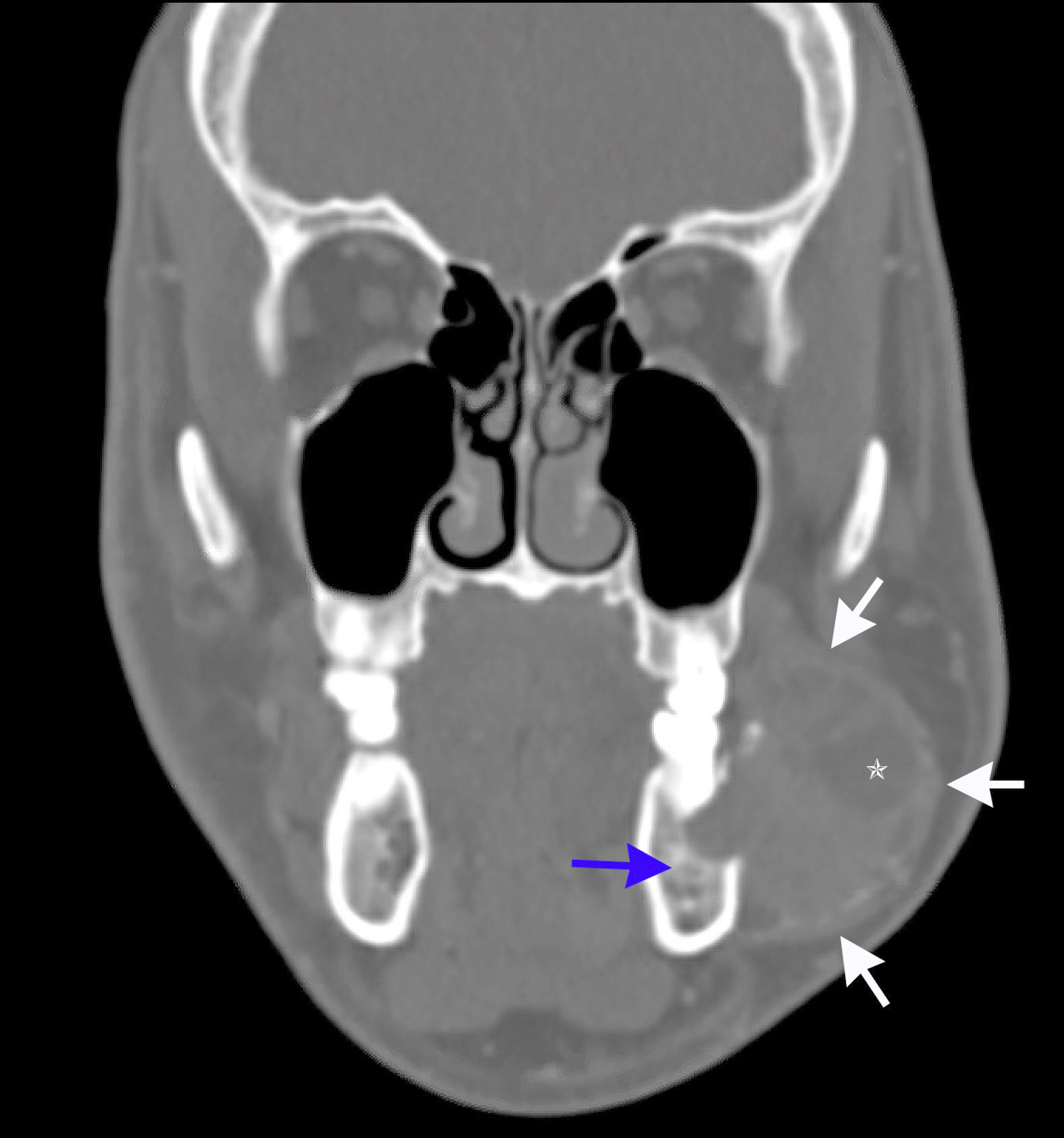 Case 3: coronal CT view