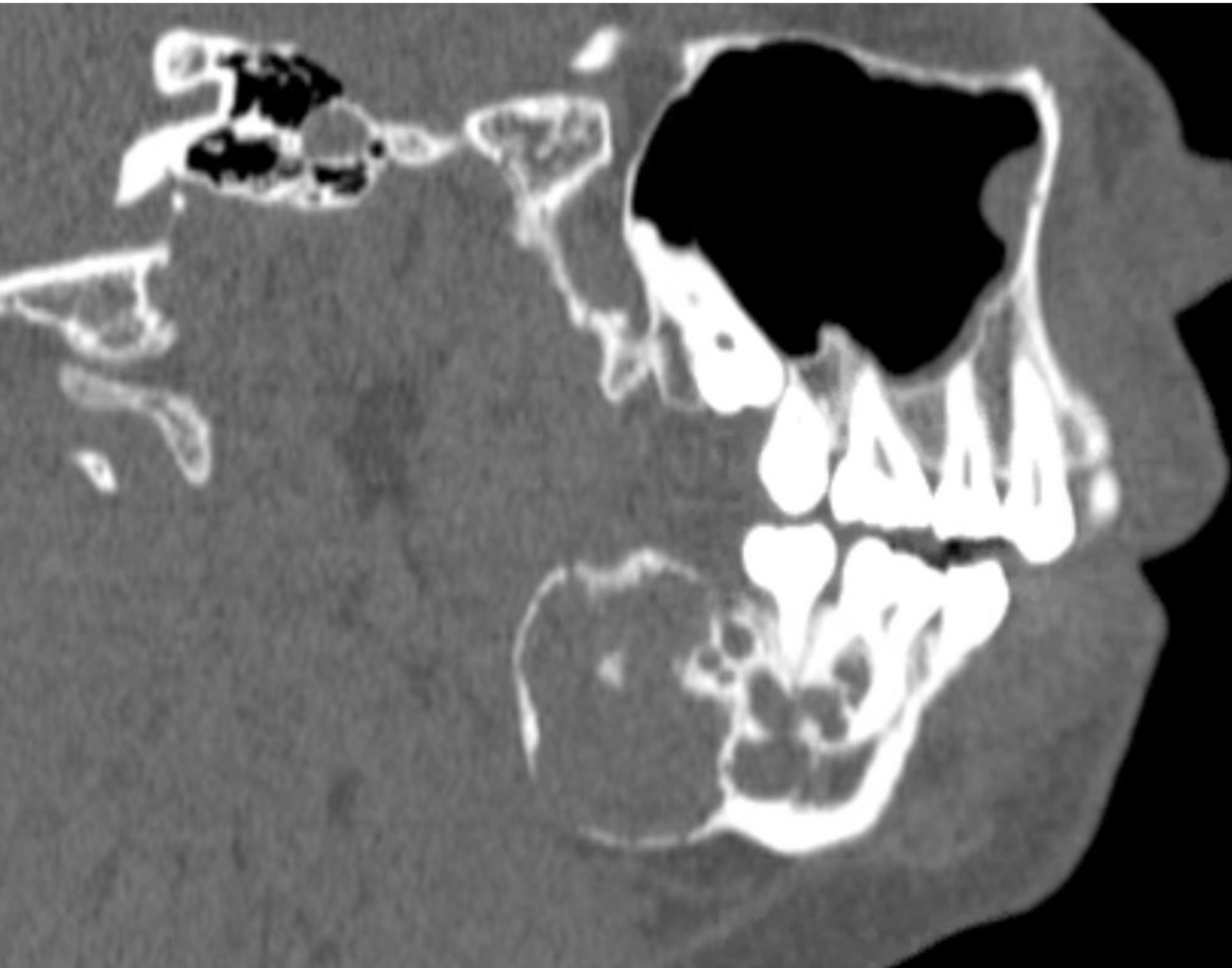 Case 2: sagittal CT view