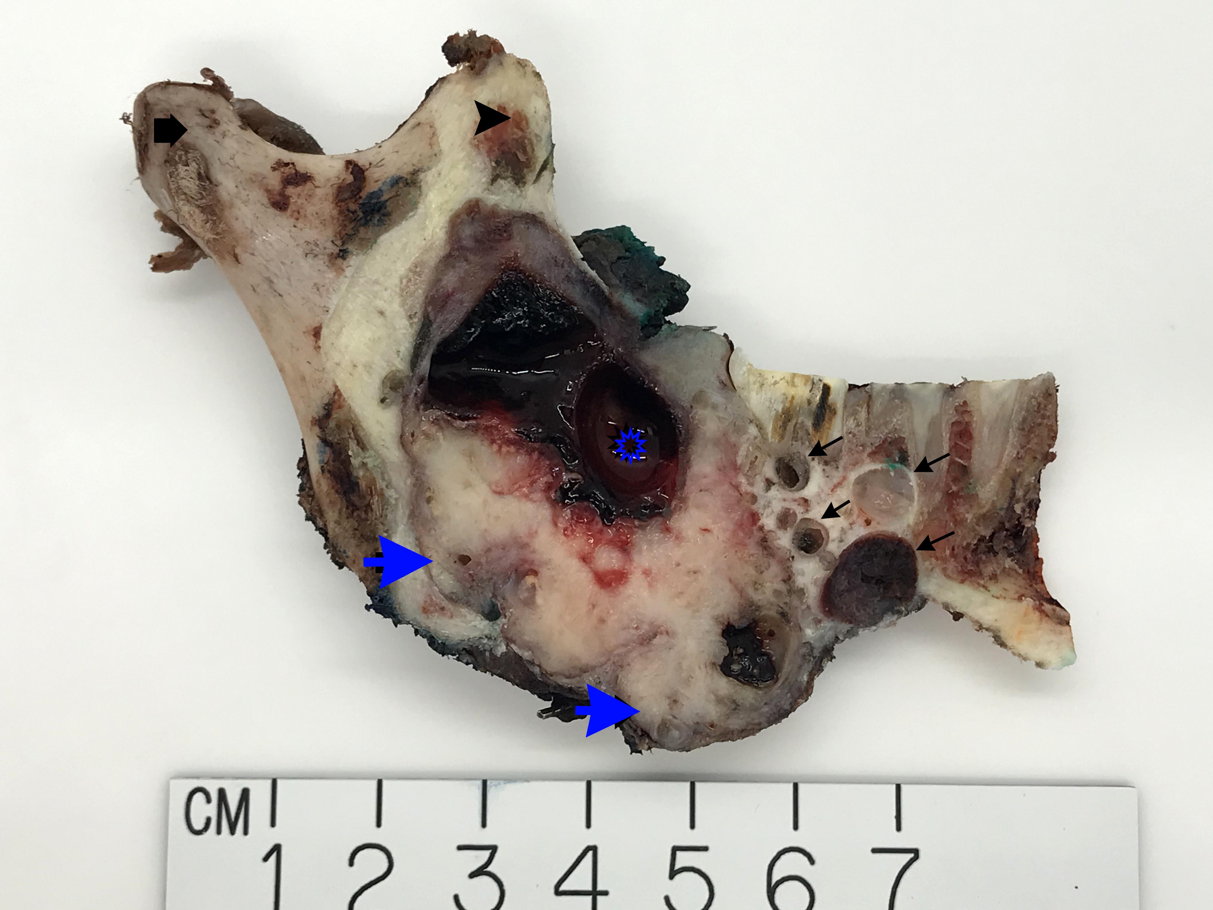 Case 1: Mandibular granular cell ameloblastoma