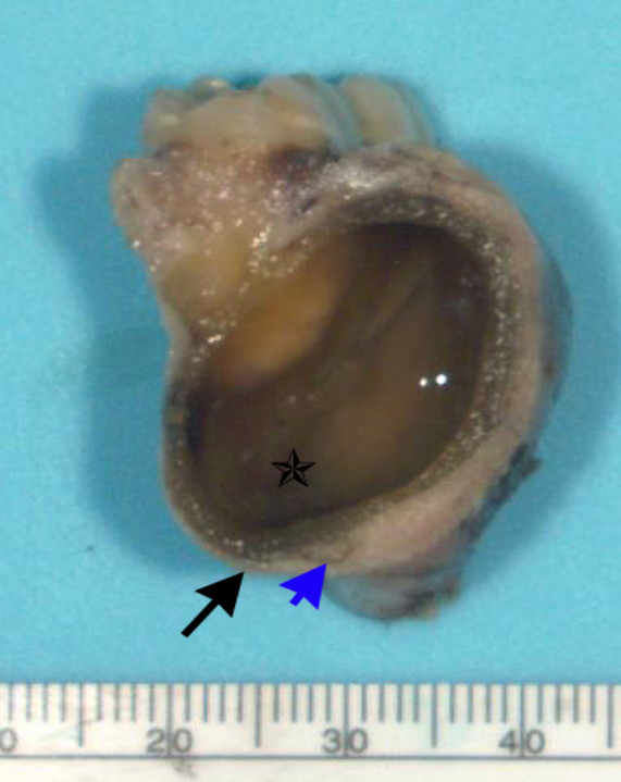 Case 5: Mandibular ameloblastoma, unicystic type