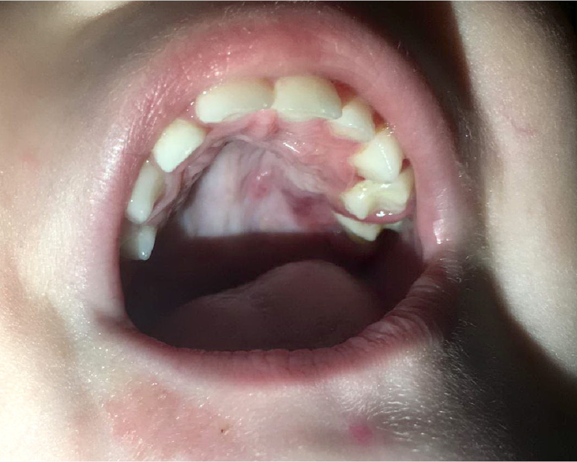 Gingival swelling