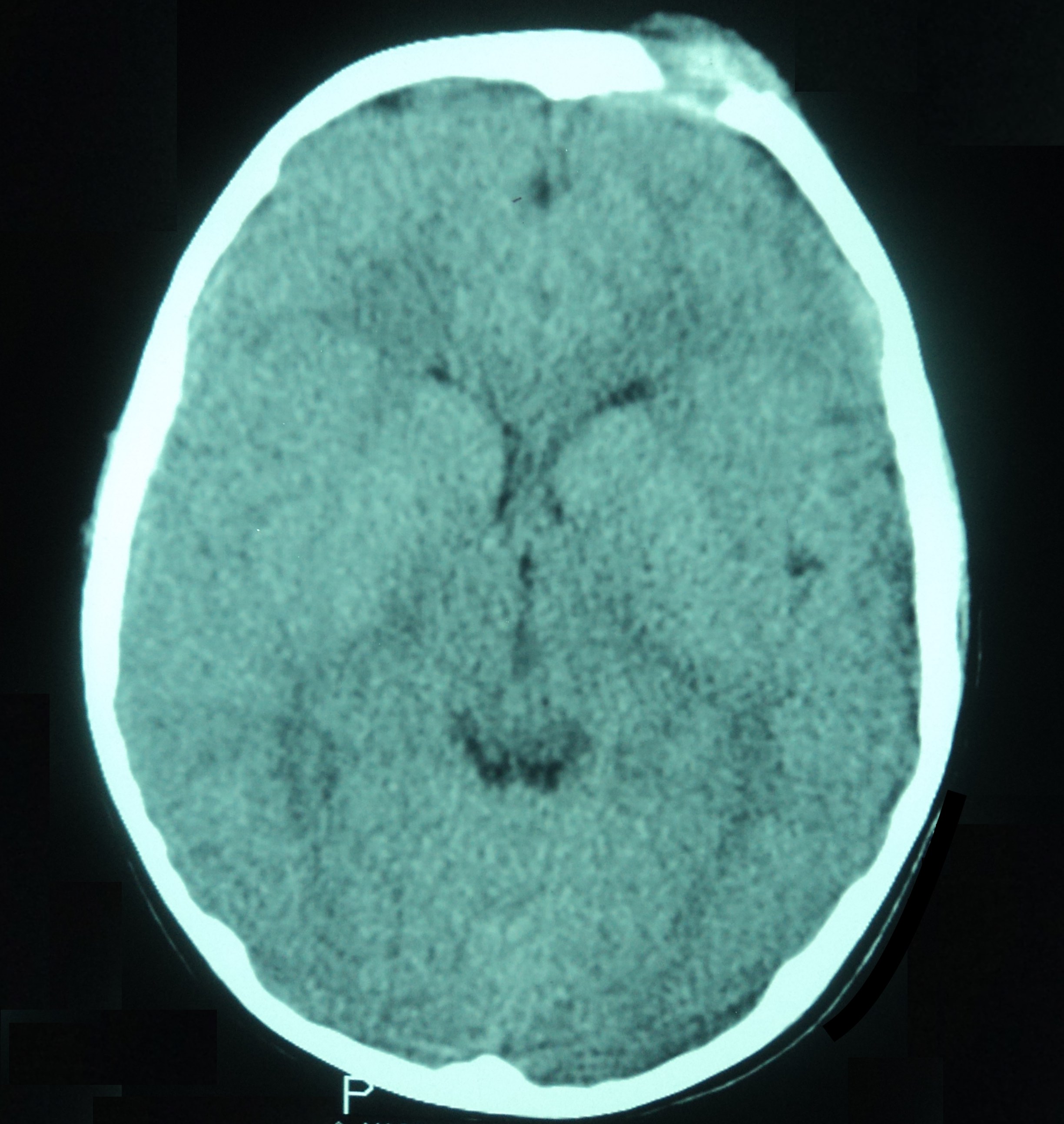 CT of brain without contrast