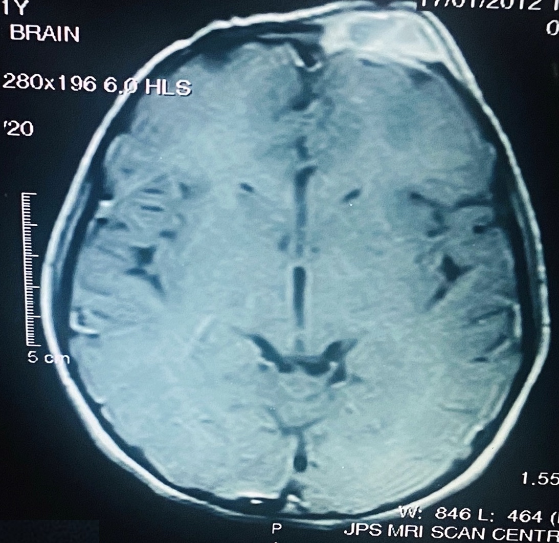 MRI of brain postcontrast