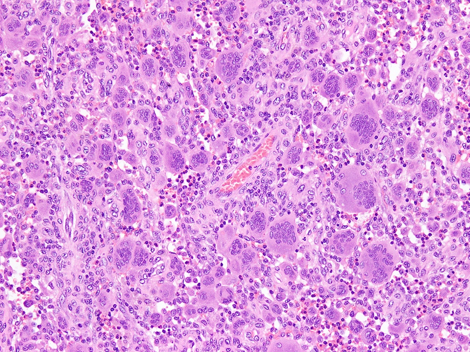 Multinucleated giant cells