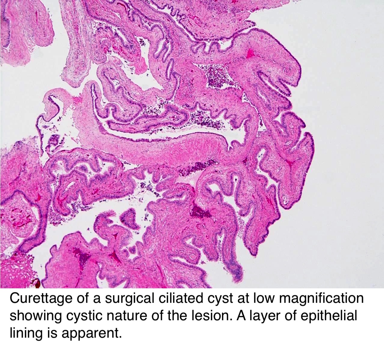 Pathology Outlines Surgical Ciliated Cyst