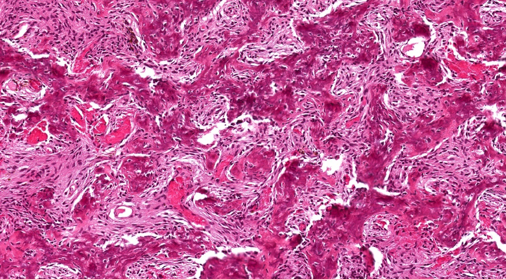 Juvenile trabecular ossifying fibroma
