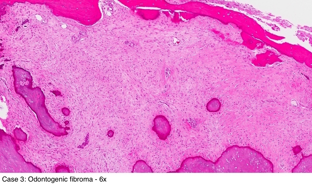 Pathology Outlines - Odontogenic fibroma