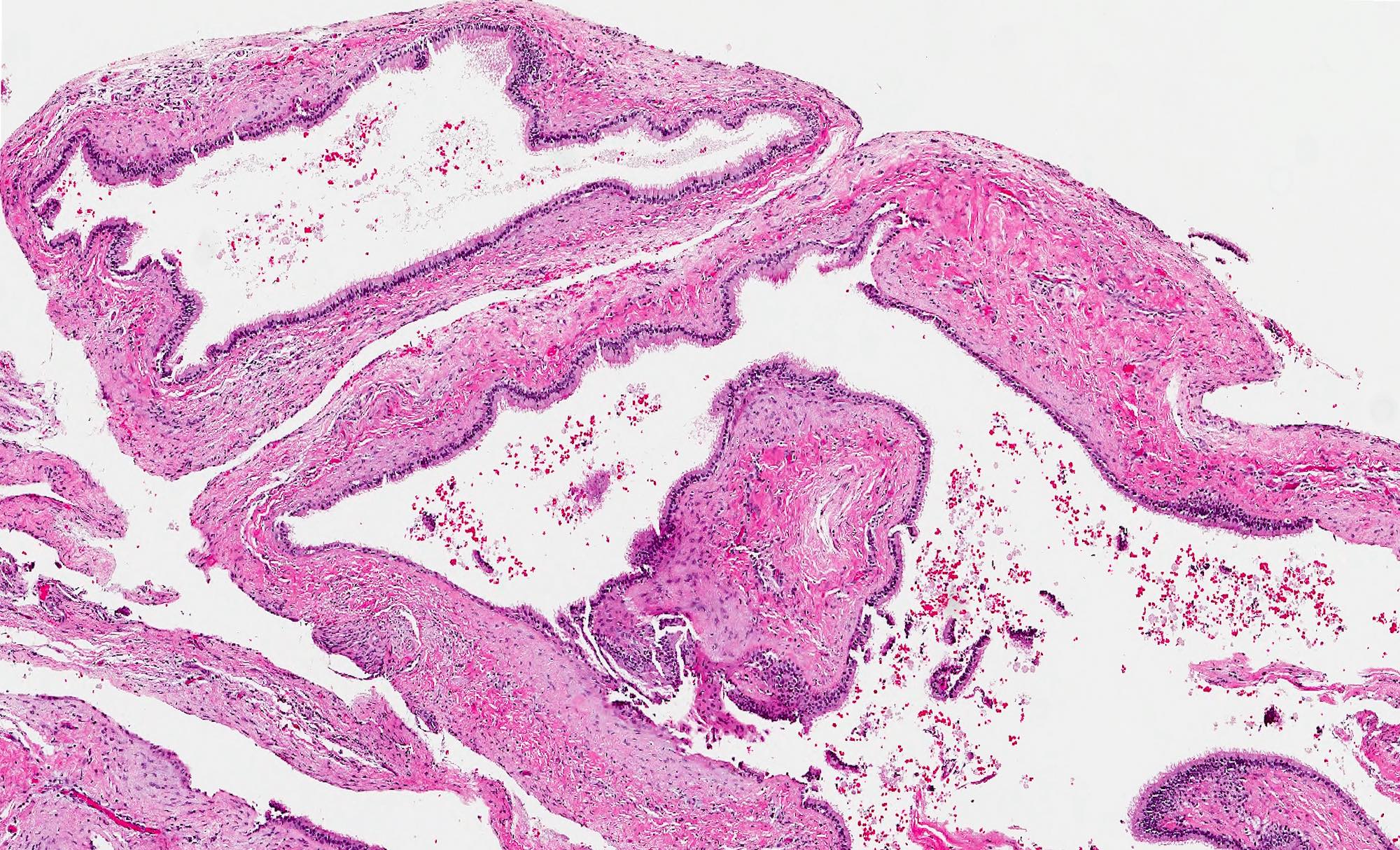 Mucocele Upper Lip Pathology Outlines