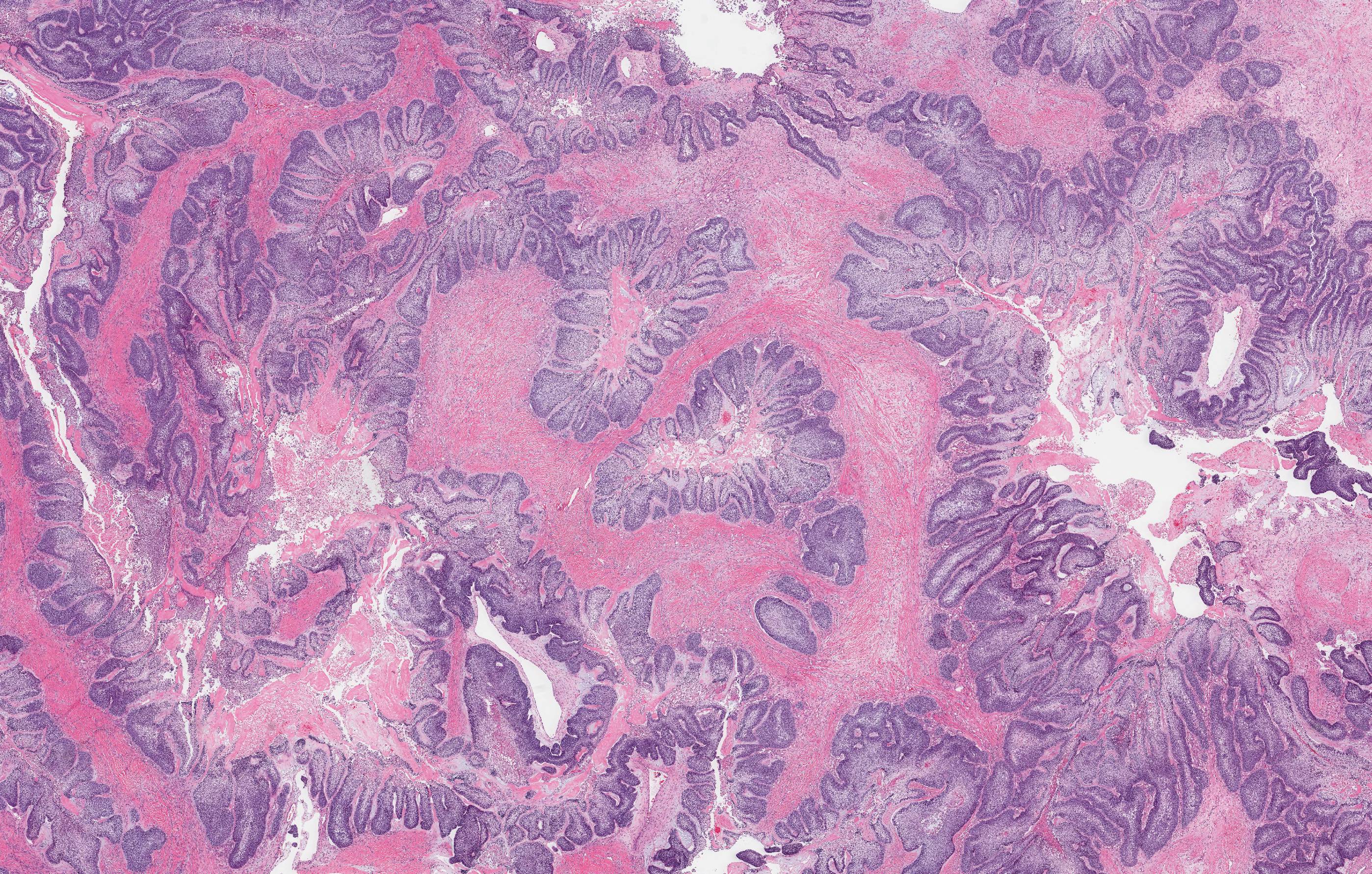 Ameloblastic carcinoma