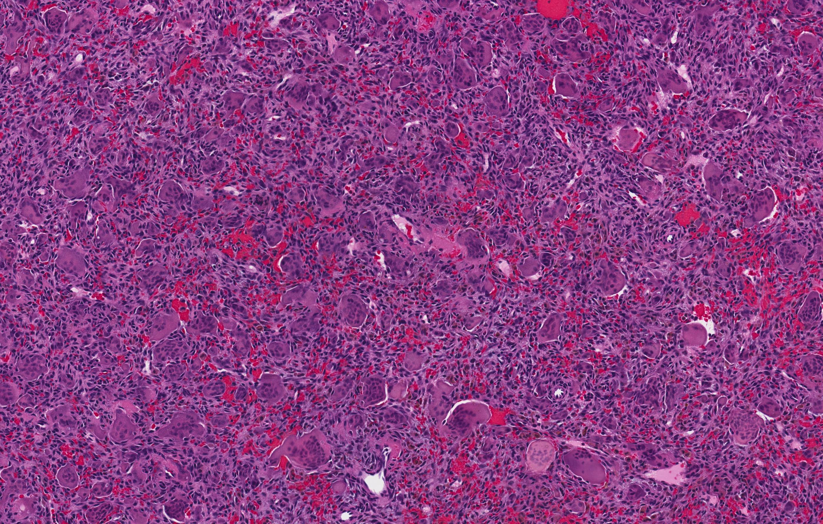 Central giant cell granuloma