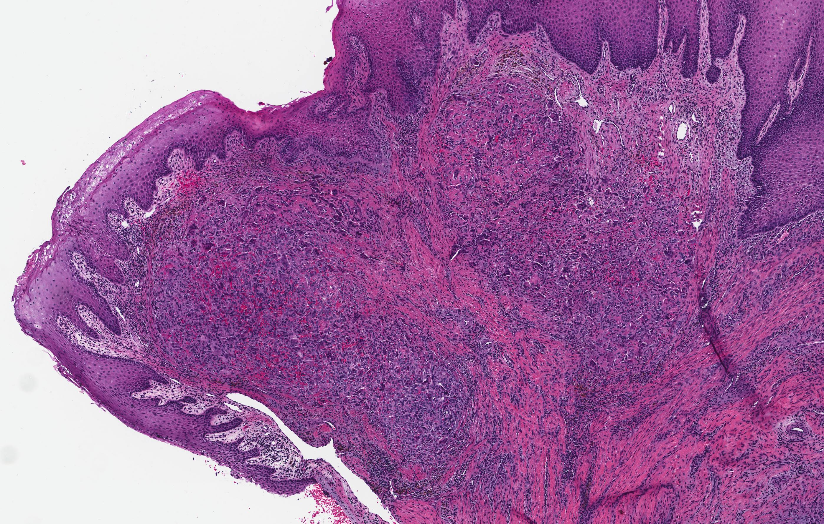 Peripheral giant cell granuloma