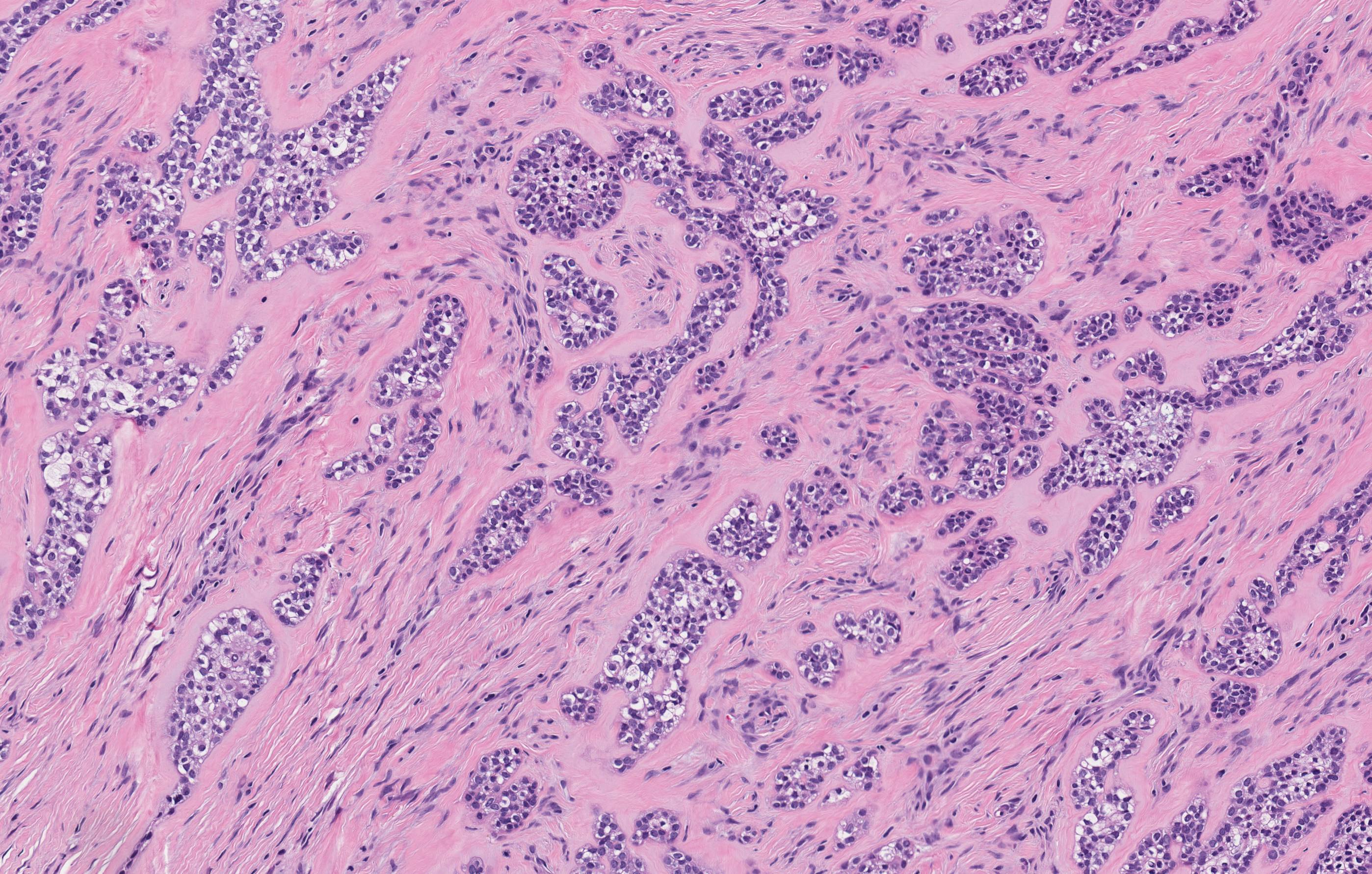 Clear cell odontogenic carcinoma