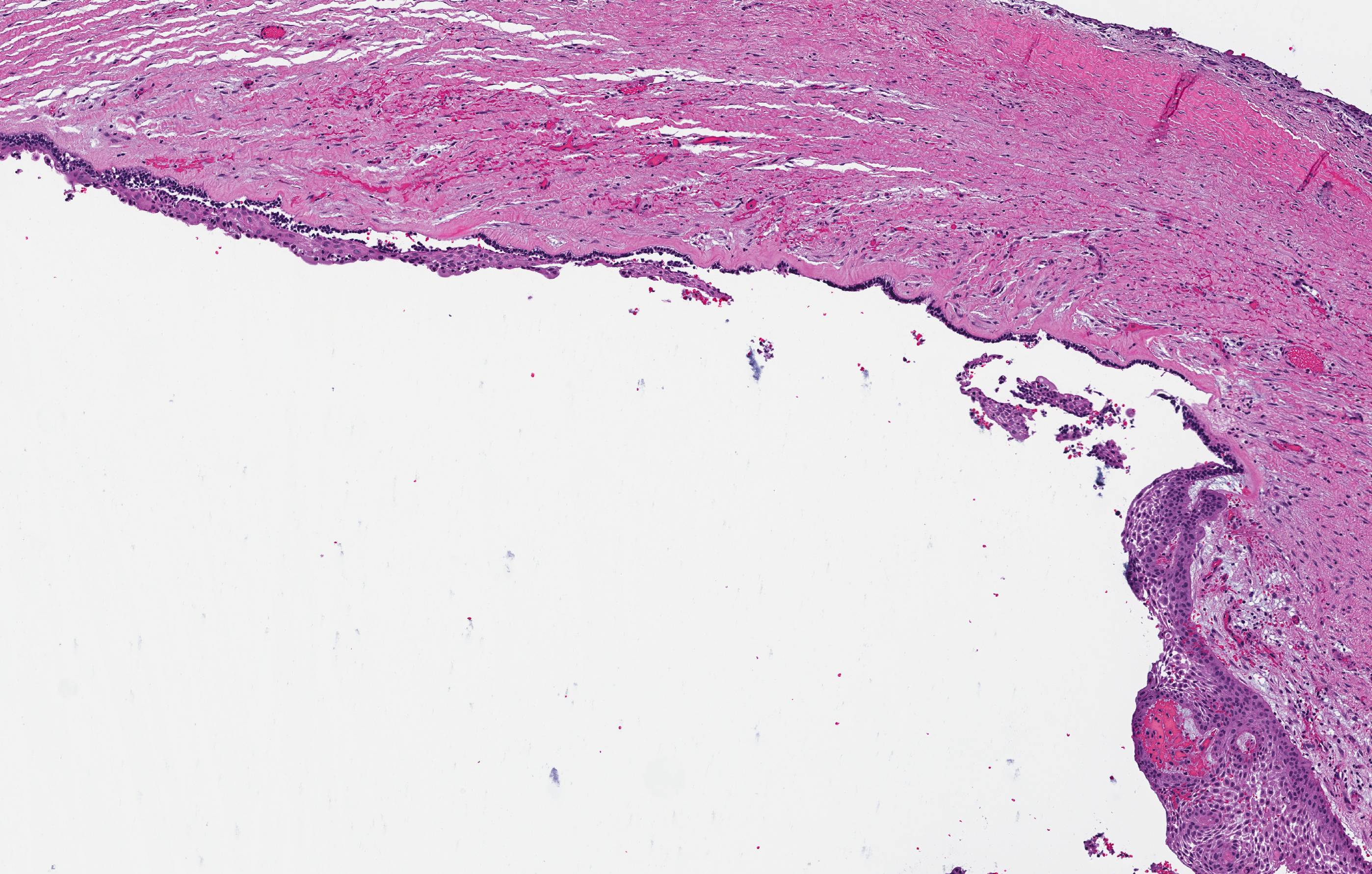 Ameloblastoma, unicystic type
