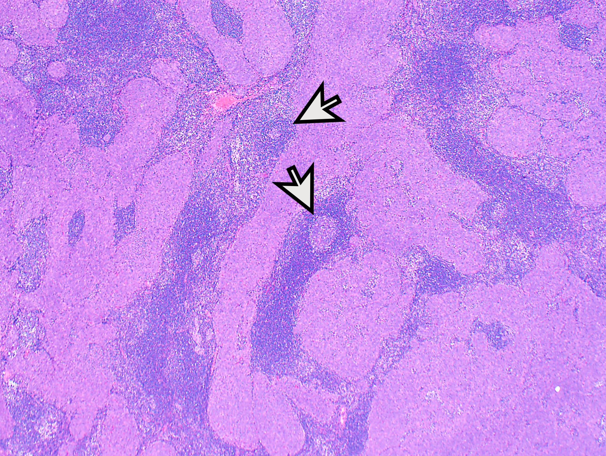 Micronodular thymoma with lymphoid stroma 