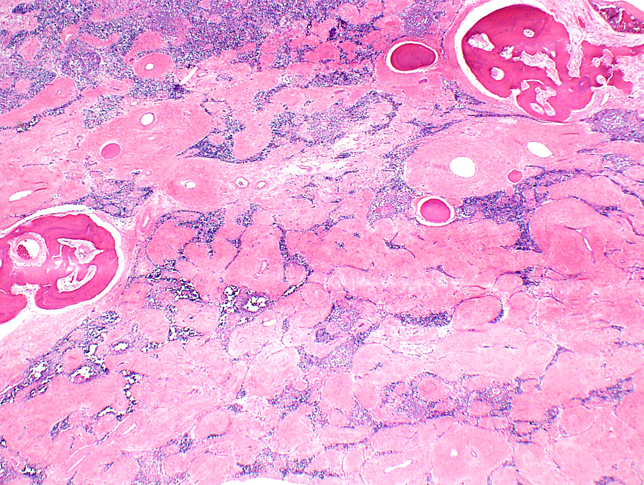Thymoma with extensive sclerosis and ossification