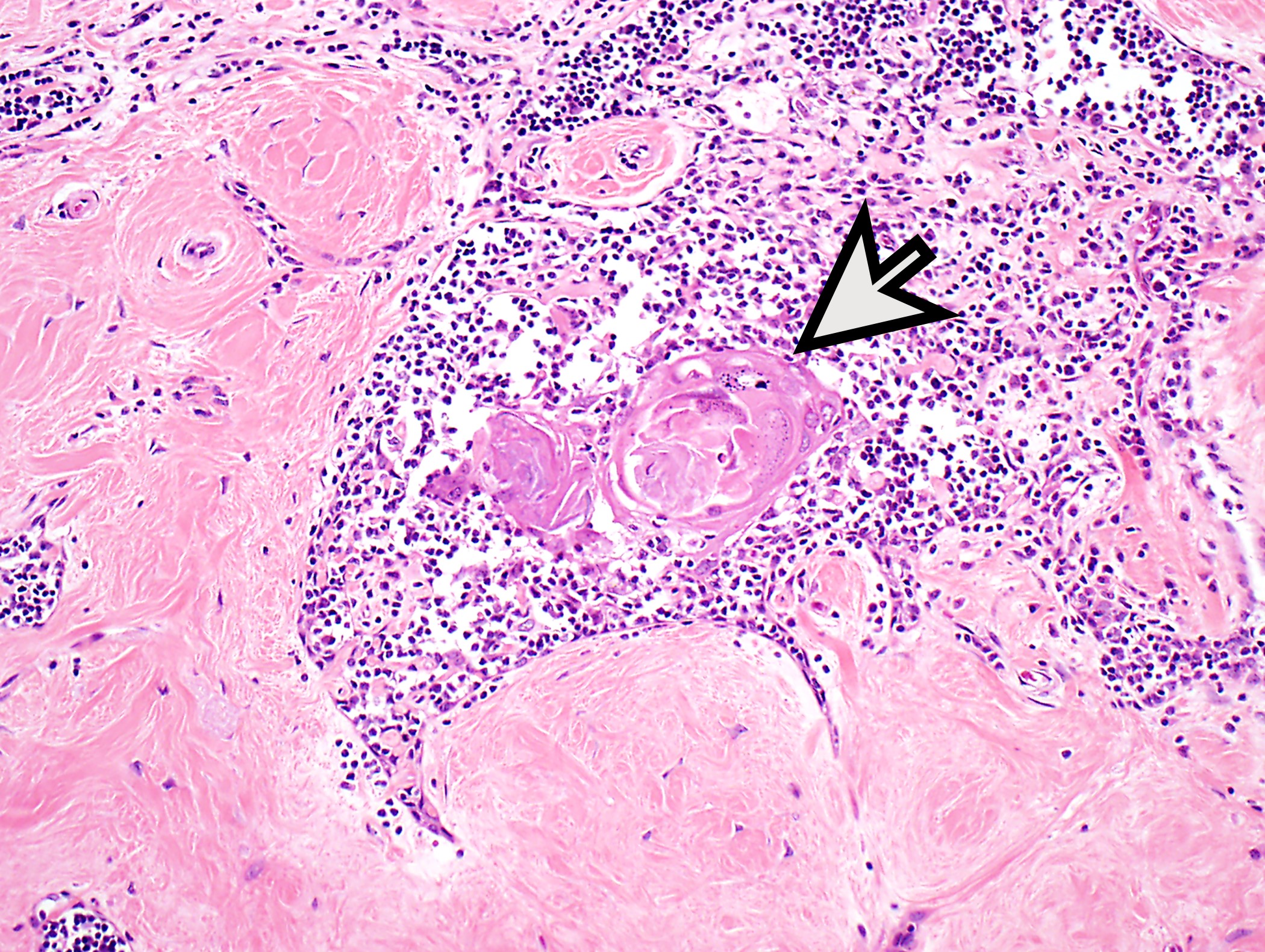 Thymoma with extensive sclerosis and ossification