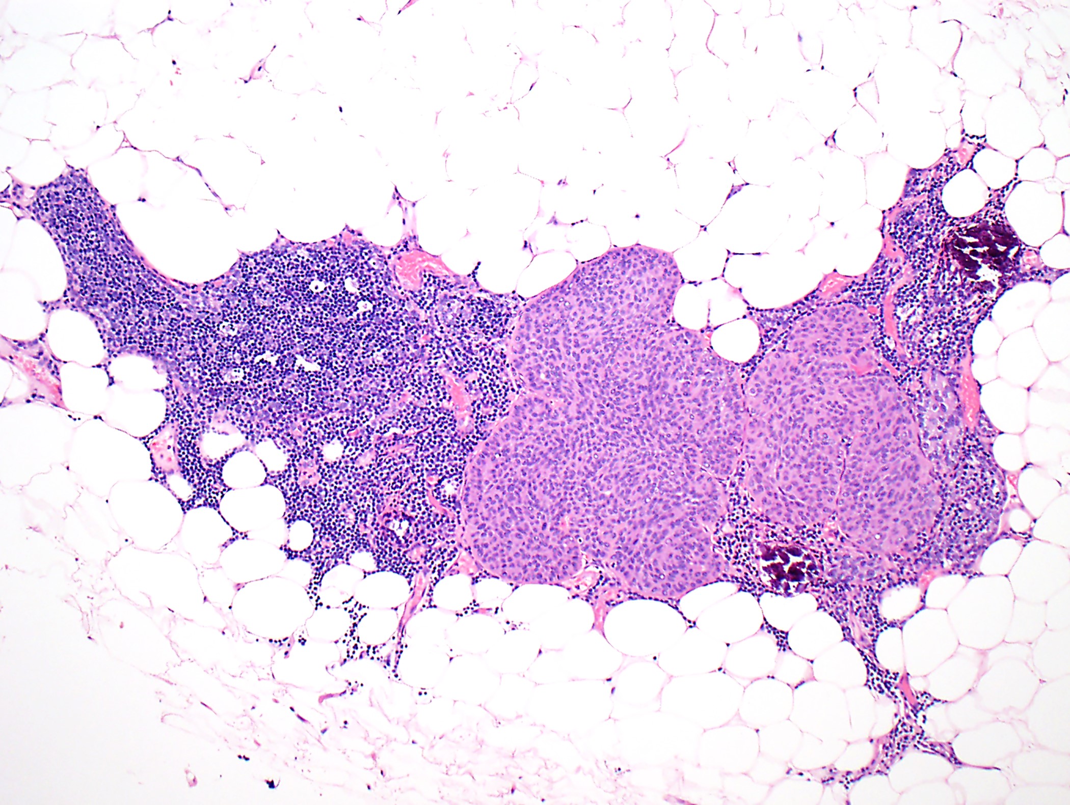 Small thymic epithelial cell nest