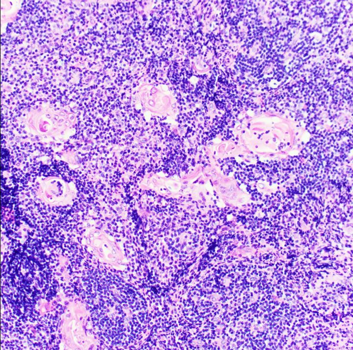 Pathology Outlines True thymic hyperplasia