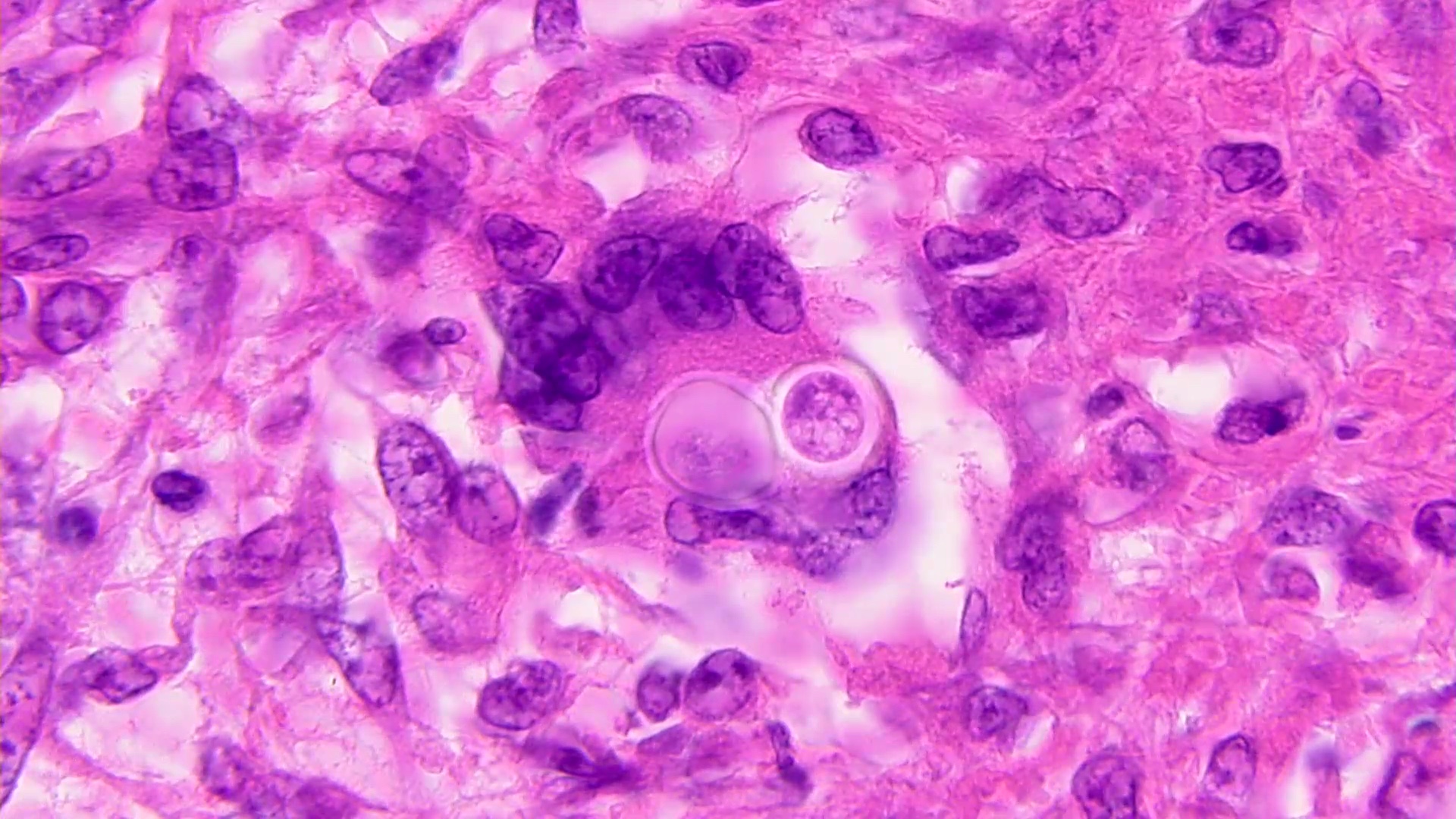 Multinucleated giant cell with yeasts